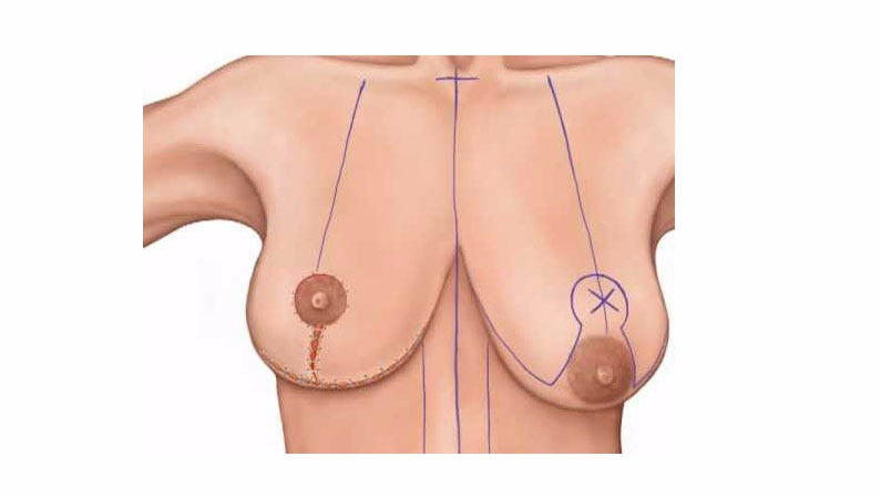 mamoplastia x mastopexia